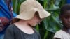 This girl survived an abduction in April 2019 the night when her albino brother Goodson was abducted in Dedza district in central Malawi. (Lameck Masina/VOA)