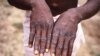 WHO Monkeypox